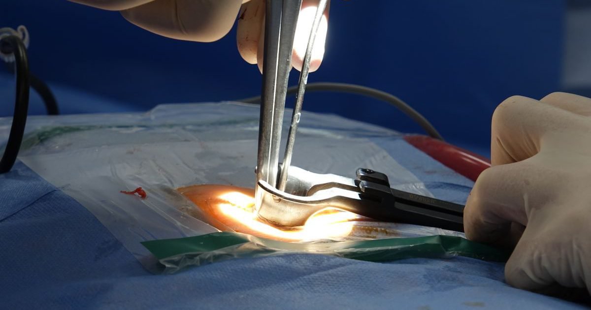 Cirurgião manipulando instrumental iluminado durante procedimento na coluna