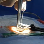 Cirurgião manipulando instrumental iluminado durante procedimento na coluna