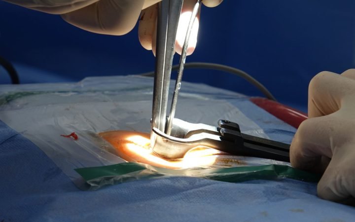 Cirurgião manipulando instrumental iluminado durante procedimento na coluna