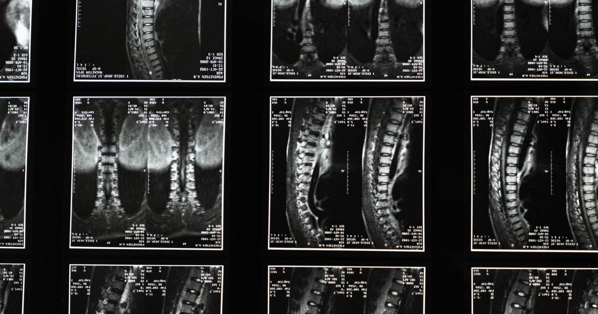 Série de imagens de ressonância magnética da coluna vertebral em cortes sagitais e coronais