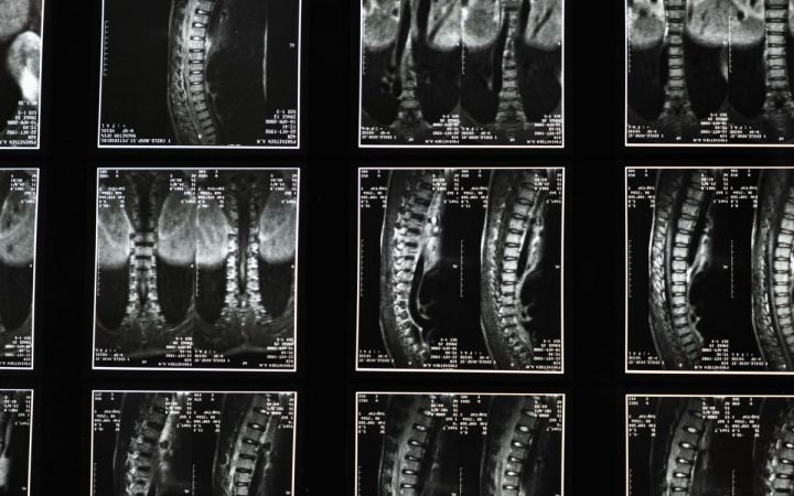 Série de imagens de ressonância magnética da coluna vertebral em cortes sagitais e coronais