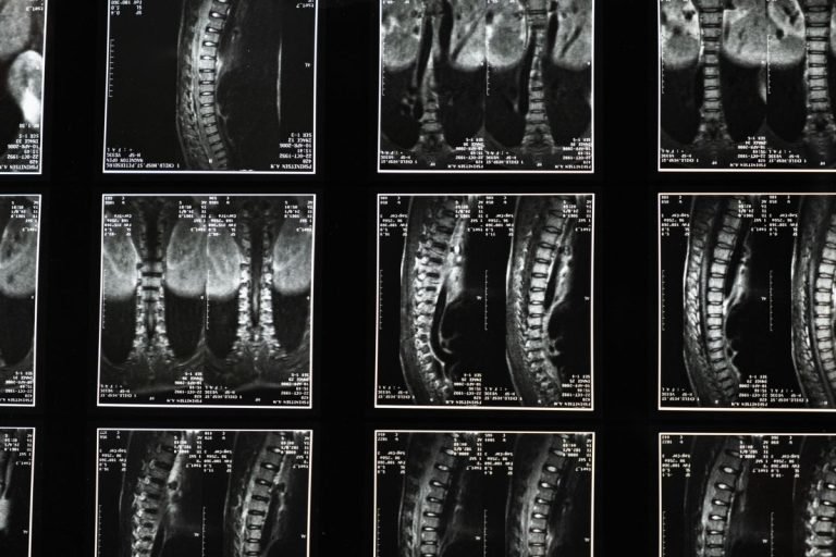 Série de imagens de ressonância magnética da coluna vertebral em cortes sagitais e coronais